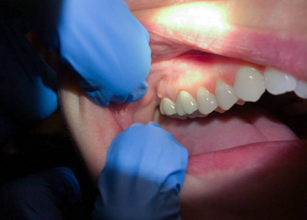 Best Emergency Dentist for Lost Fillings or Crowns in Anniston, AL