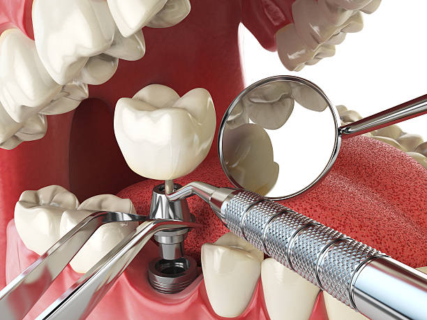 Best Emergency Dentist for Knocked-Out Tooth in Anniston, AL